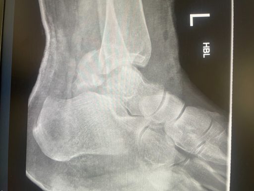 Ankle fracture with talus fracture